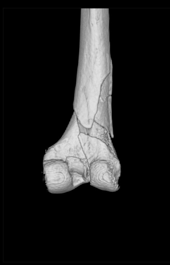 3D model from CT scan of reconstructed right femur (around and above the knee).