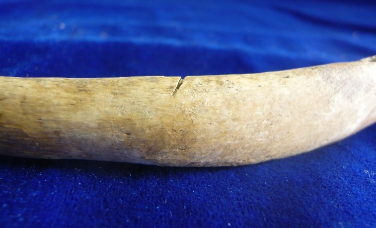 Rib bone with injury against blue background.