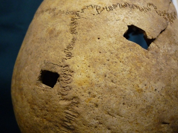 Close-up of injured skull.